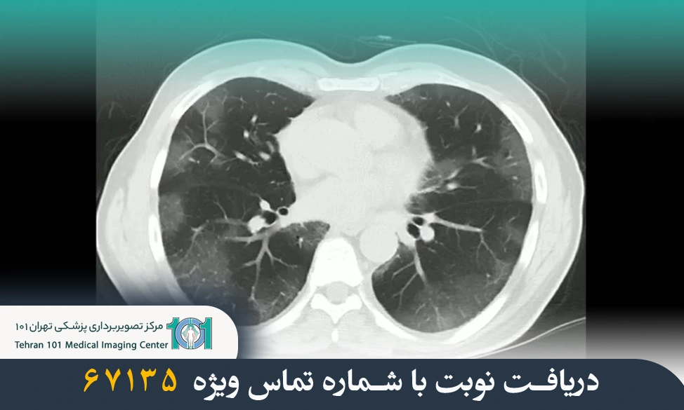 سی تی اسکن ریه چیست؟ بررسی کاربردها، مراحل انجام و دلایل استفاده از آن 4 سی تی اسکن ریه