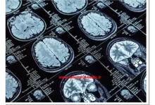 آیا ام آر آی مغز خطرناک است؟ 10 آیا ام آر آی مغز خطرناک است