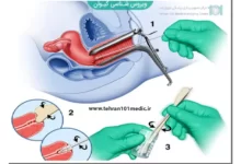 بیوپسی زگیل تناسلی چگونه انجام میشود؟ 51 بیوپسی زگیل تناسلی