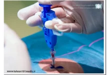 بیوپسی ریه: تشخیص دقیق، درمان سریعتر! 52 بیوپسی ریه