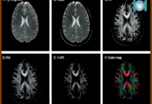 تصویربرداری دیفیوژن تنسور چیست 19 تصویربرداری دیفیوژن تنسور چیست